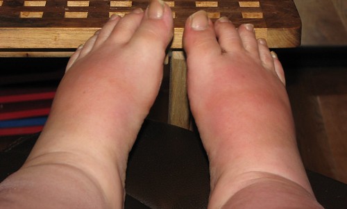 My swollen feet