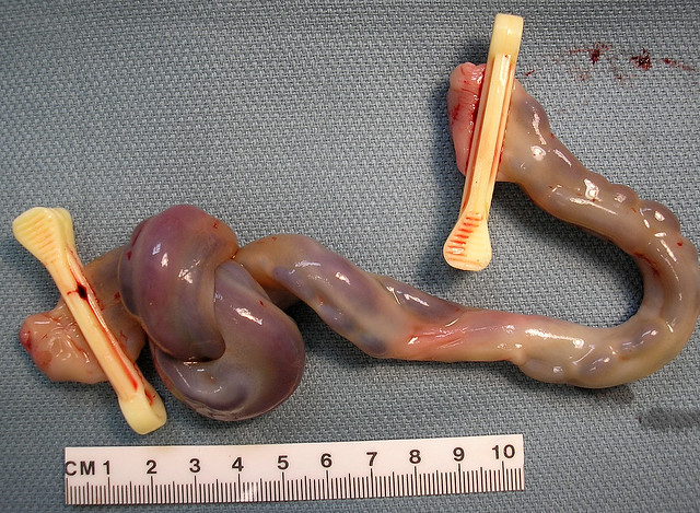 Qiao's Pathology: True knot of umbilical cord