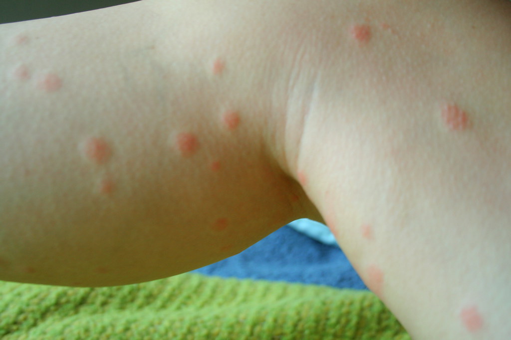 Chigger Bite Vs Bed Bug Bite Identifying Insect Bites Wellbeing