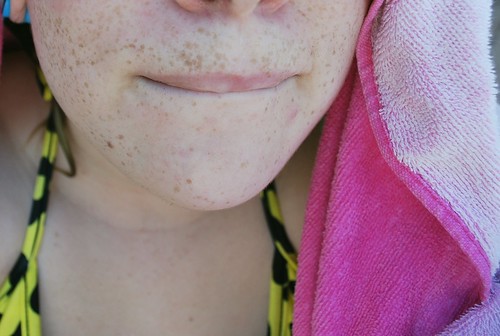 Freckles!