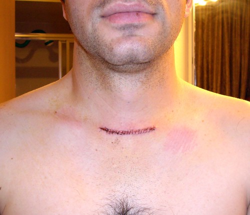 Thyroid Scar Taken Two Days After Surgery This Doctor Use Flickr