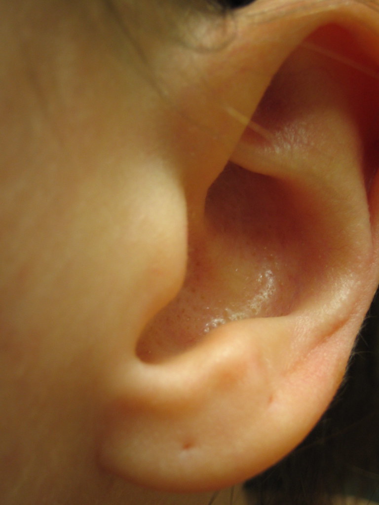 Left ear, this summer, pre-stretching