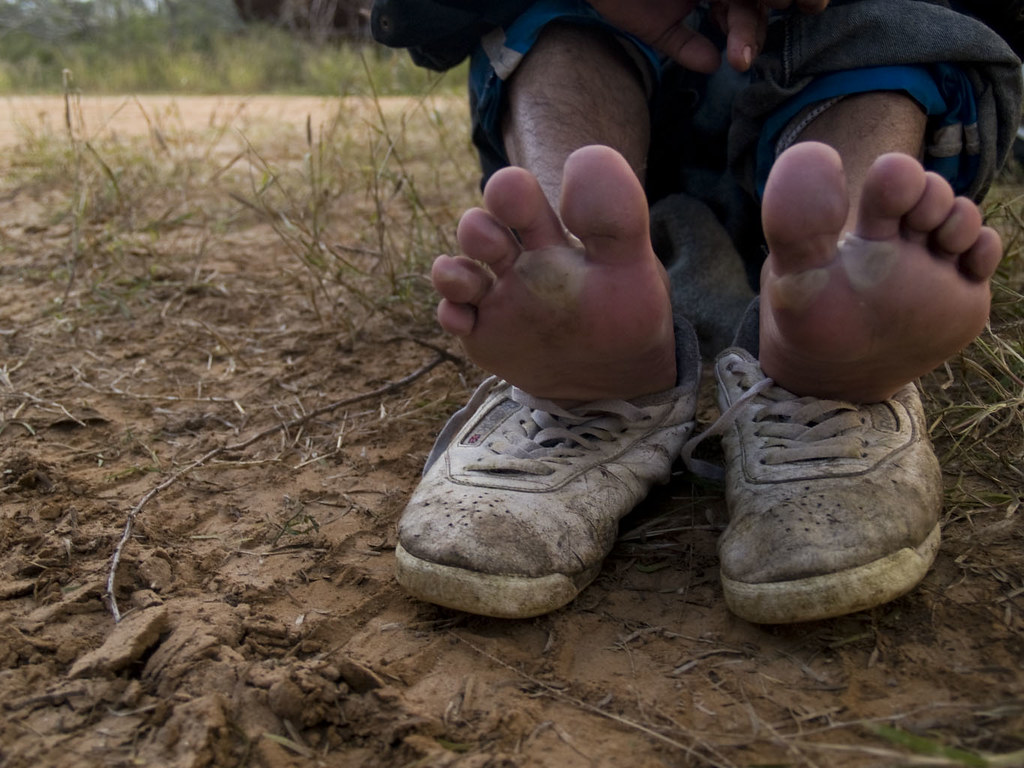 Blisters | The feet of a 20 year old immigrant from Honduras… | Flickr