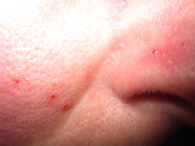 My Rosacea (facial red and spotty rash) has flared up again - March 2010