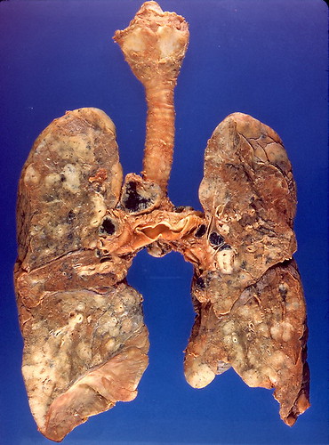 Lymphoma, NOS | by Pulmonary Pathology