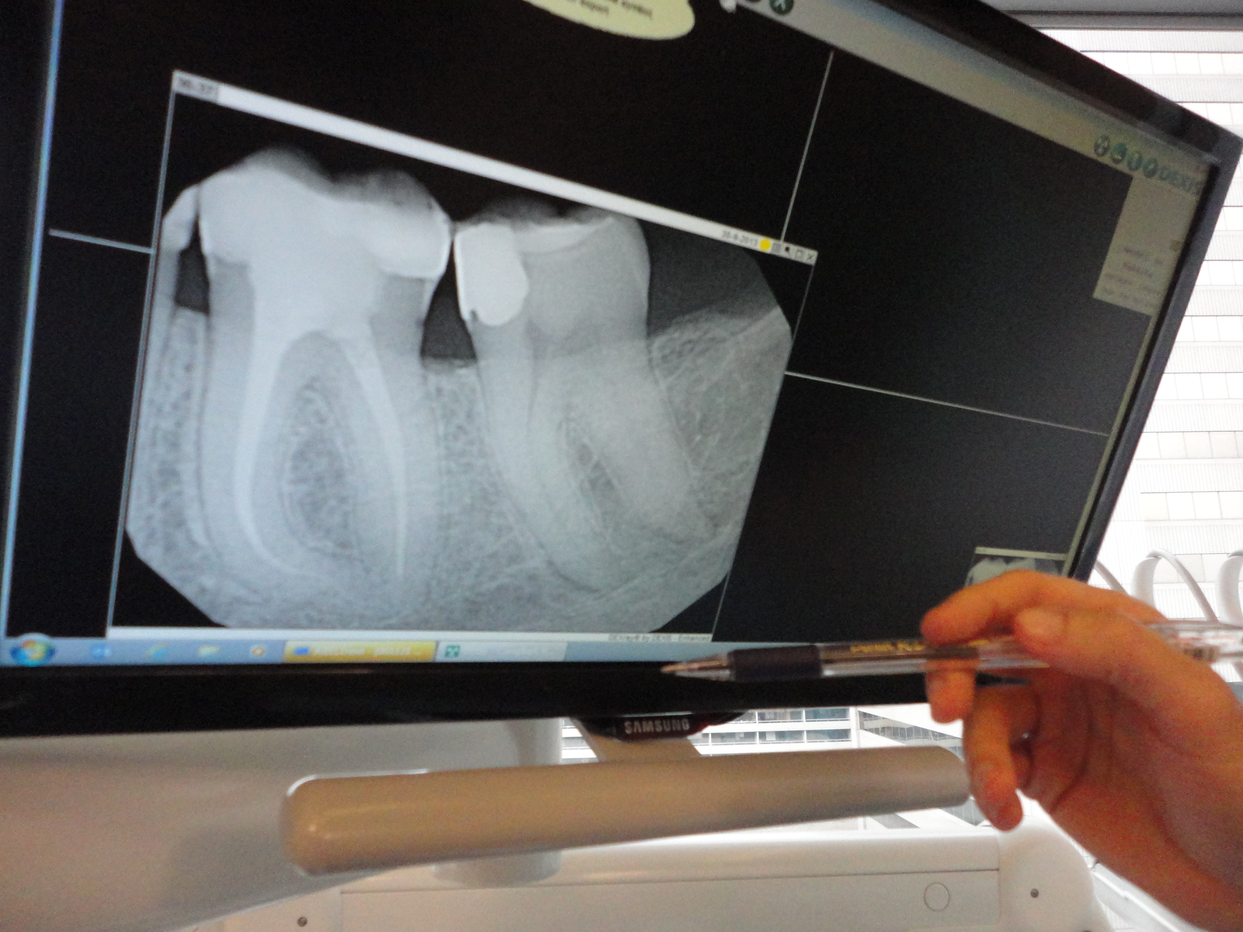 Tooth Xray at Archer Dental clinic in Toronto