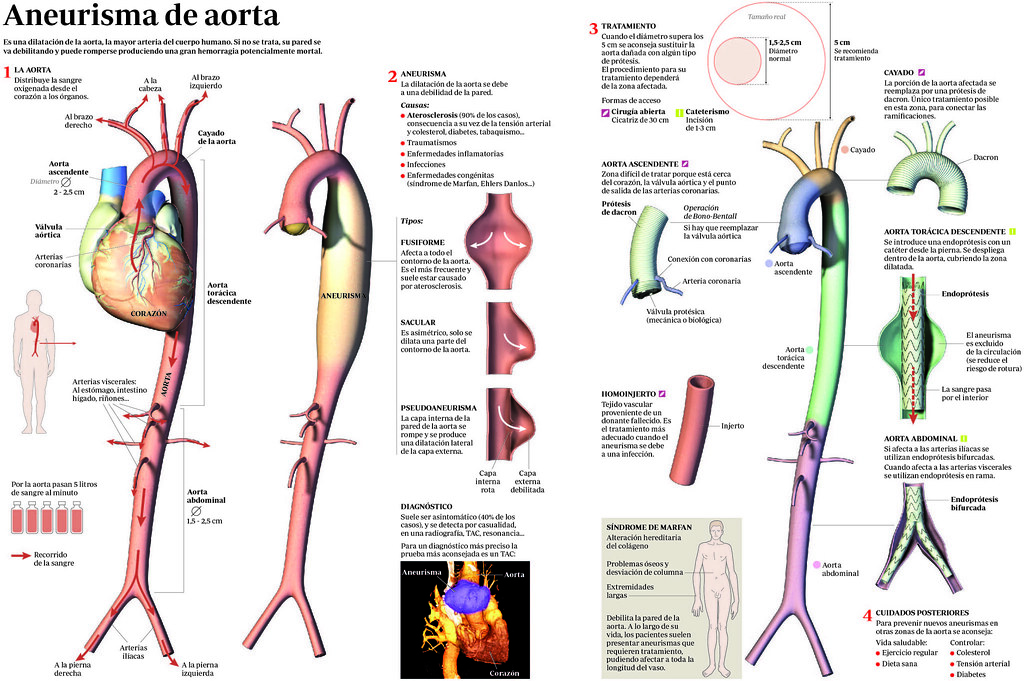 Aneurisma aorta