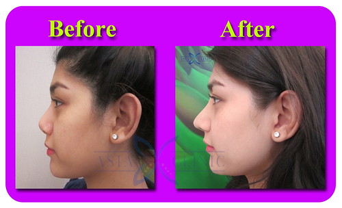 Rhinoplasty Augmentation Photos | by asia.clinic