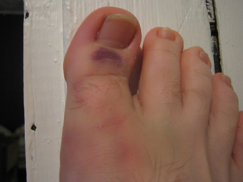 Recent Injury #1 | by nhdewitt