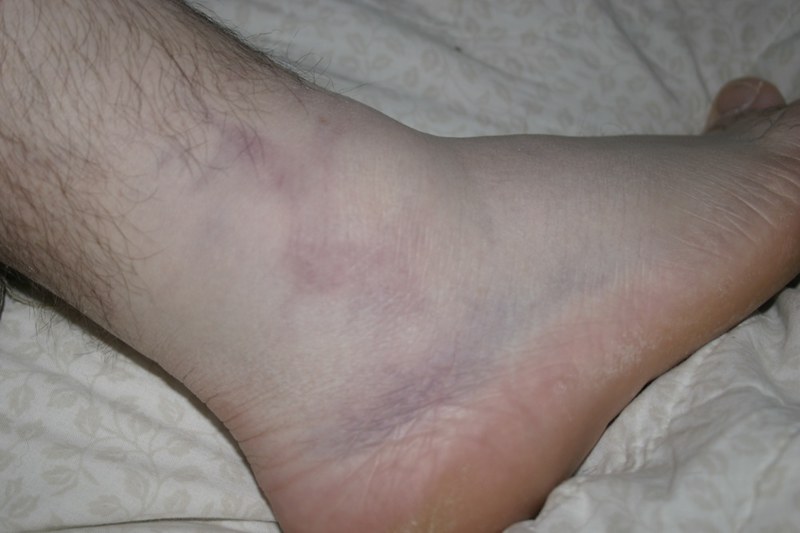My nasty ankle
