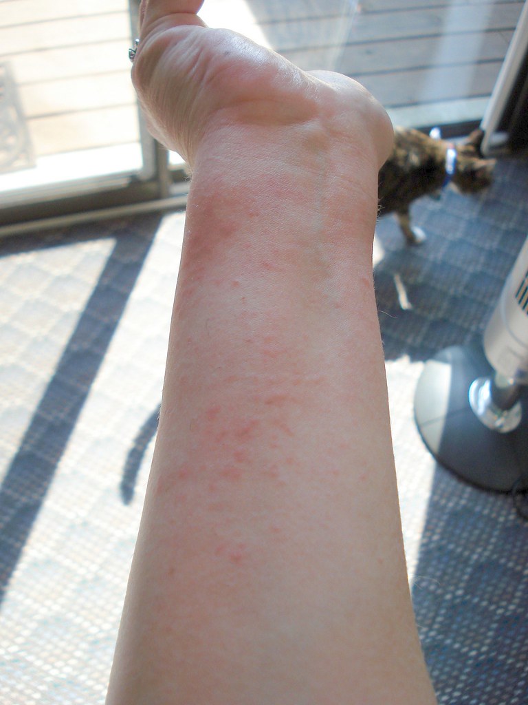 And This Is The Rash From Picking The Strawberries Flickr