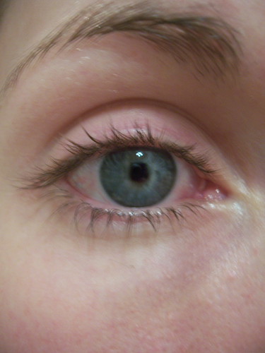 july 9. [conjunctivitis.] | by misscaro