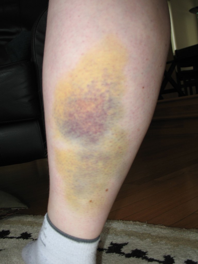 torn calf muscle, I tore my calf muscle on April 23 and thi…