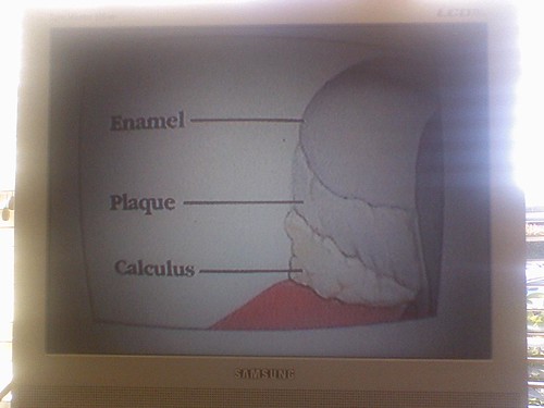 Enamel Plaque Calculus | by atduskgreg