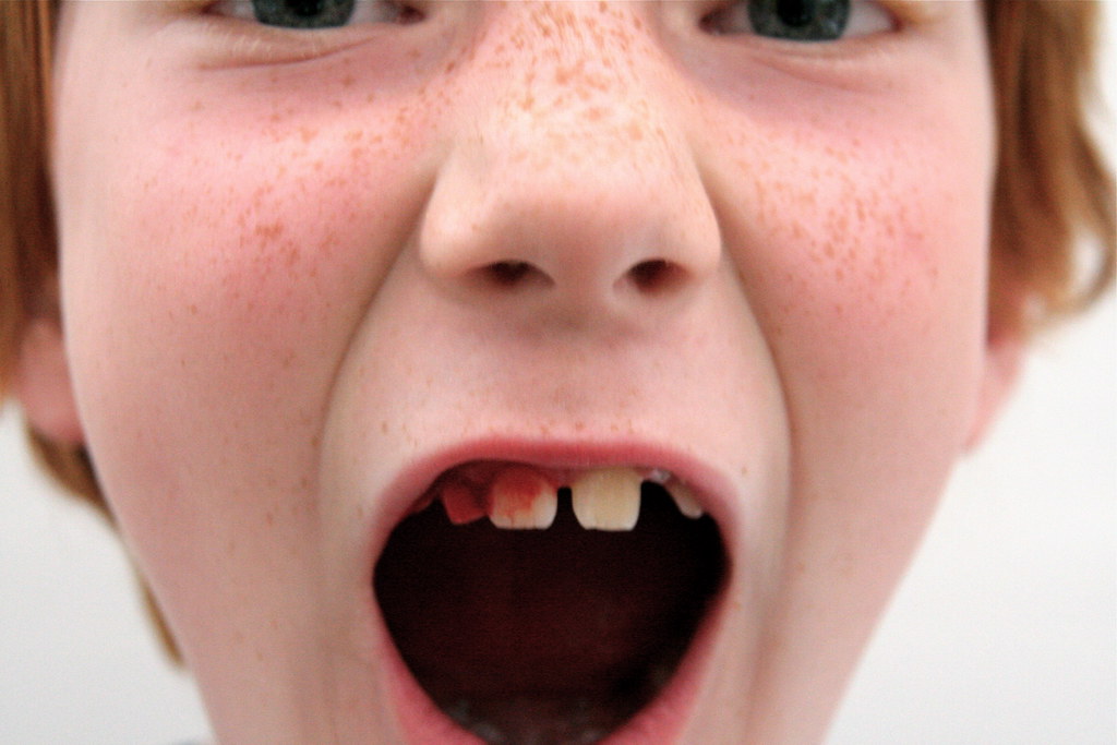 Losing teeth | This week we've lost two teeth in the Nicholl… | Flickr