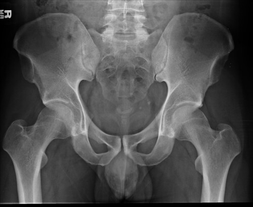 xray-pelvis | by steveler