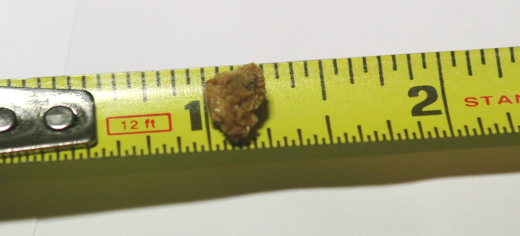 Kidney Stone! 6.35mm x 9.5mm | This kidney stone has been ca… | Flickr