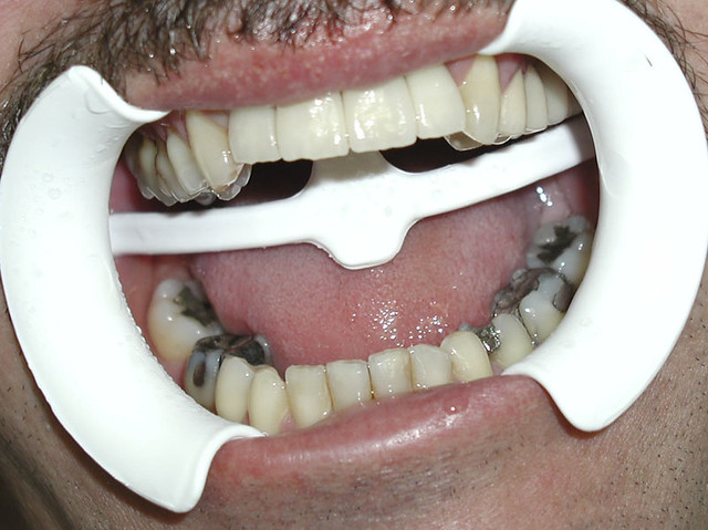 Dental Implants by Alvaro Ordonez DDS 012