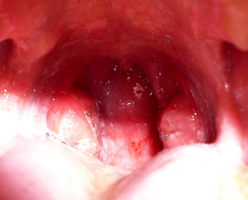 throat bacteria strep