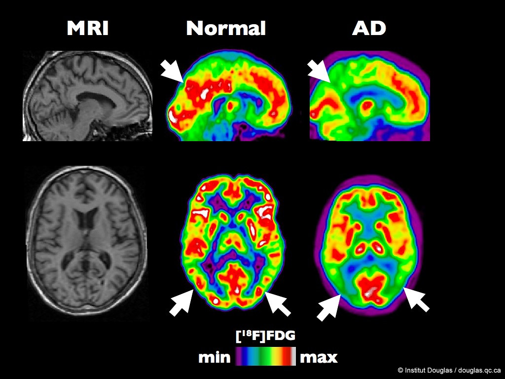 PET scan an healthy brain compared to brain at ear… | Flickr
