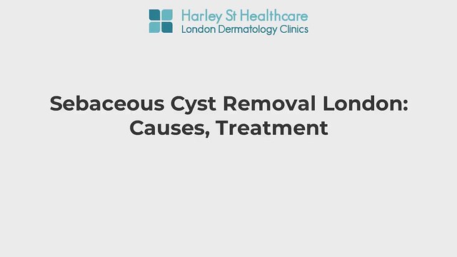 Sebaceous Cyst Removal London