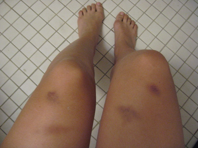 Sailing bruises