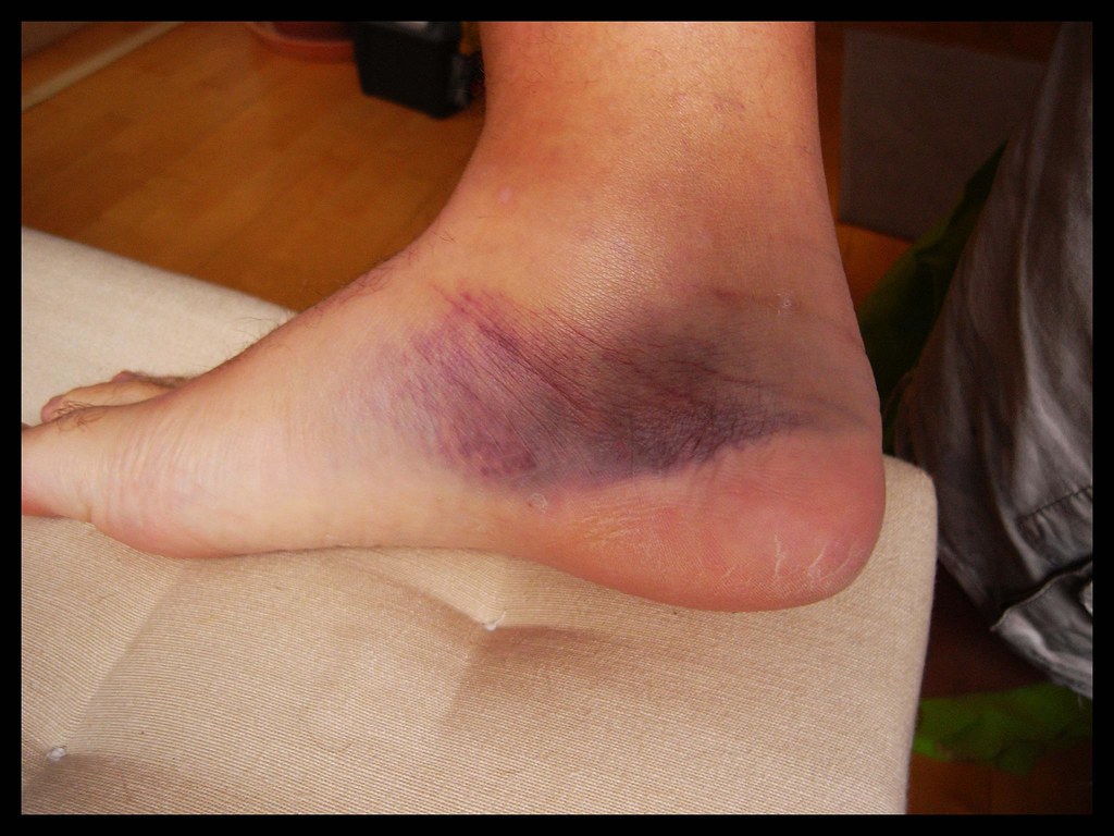 Foot Bruise | This has mostly cleared up now. Here goes a li… | Flickr