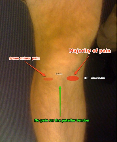 Diagram of My Knee Pain | Just thought I would actaully diag… | Flickr