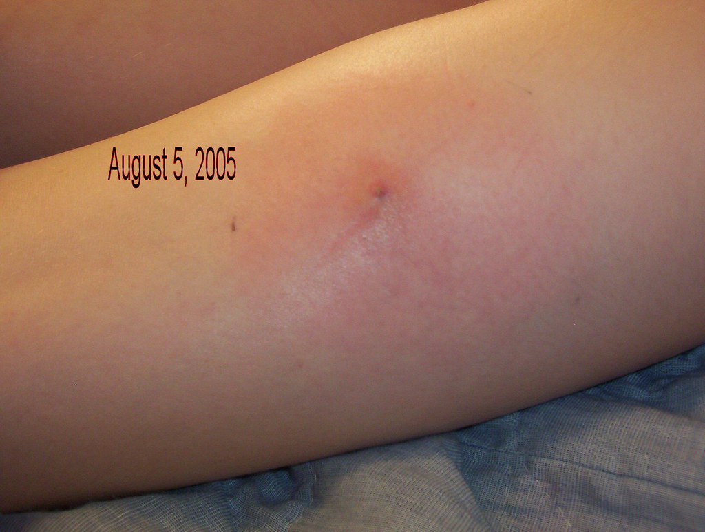 0001, Early stage of a brown recluse spider bite., Stacy McNabb