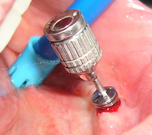 Destornillador de Implantes | by jorgecapielo