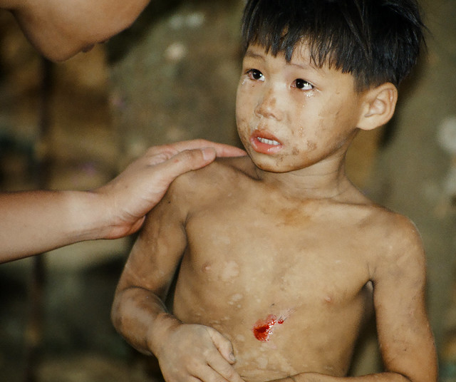 Vietnam, 1993 - Injured Boy (Fujichrome Provia)