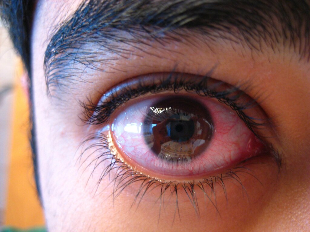 Выражены глаза. Эписклерит конъюнктивит. Эписклерит кровоизлияние.