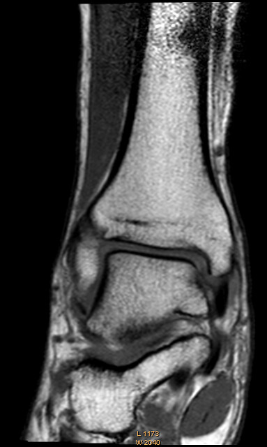 MRI foot T1 W weighting 3T