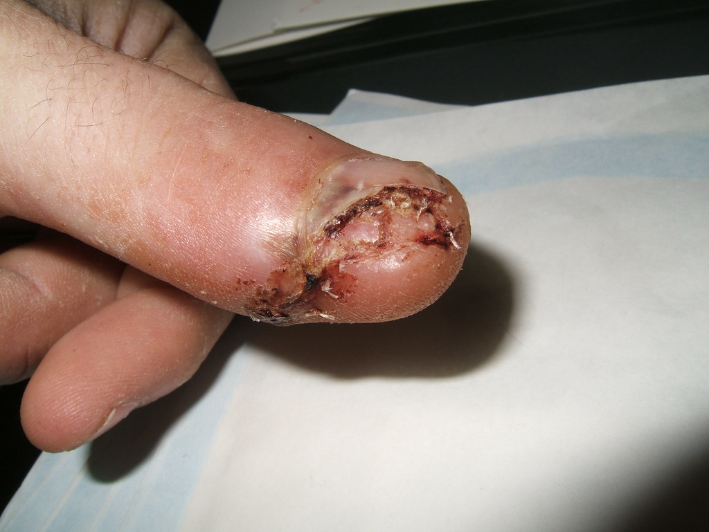 My Thumb Injury