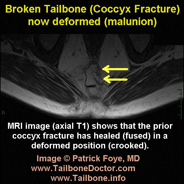 Tailbone MRI deformed coccyx pain Foye - a photo on Flickriver