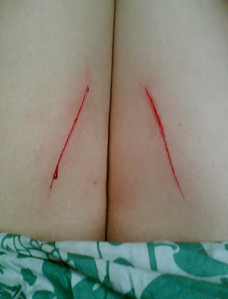 Cuts On Thighs