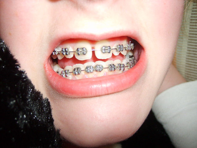 Anna's braces November 2008