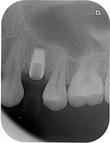Implant4.5mm by 8.0mm | by jonpaulseah