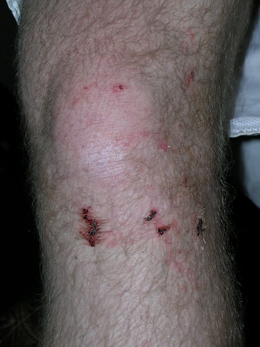 Some of Mike's wounds
