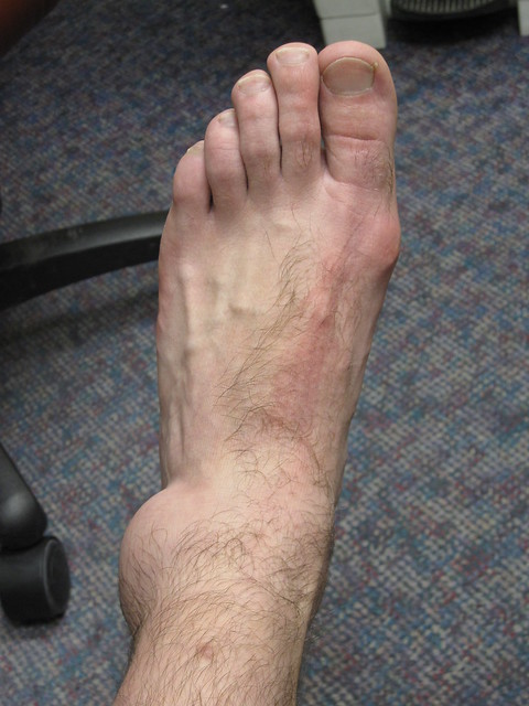 Ankle Damage