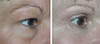 eyelid-surgery-2-093 13
