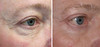 eyelid-surgery-1-014 13
