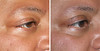 eyelid-surgery-3-022 1
