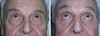 eyelid-surgery-1-062 6