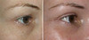 eyelid-surgery-3-003 1