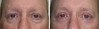 eyelid-surgery-5-020 0