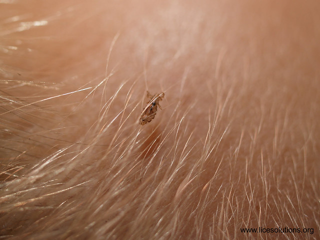 Head Lice - Female Louse On Hair Zoomed In On