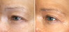 eyelid-surgery-7-024 10