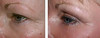 eyelid-surgery-1-055 15