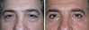 eyelid-surgery-2-029 6